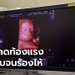 ว่าที่คุณพ่อใจสลาย เมียท้อง 6 เดือน แท้งลูกหลังอัลตร้าซาวด์ 4D ชี้หมอท้องกดแรง-พูดหยาบ