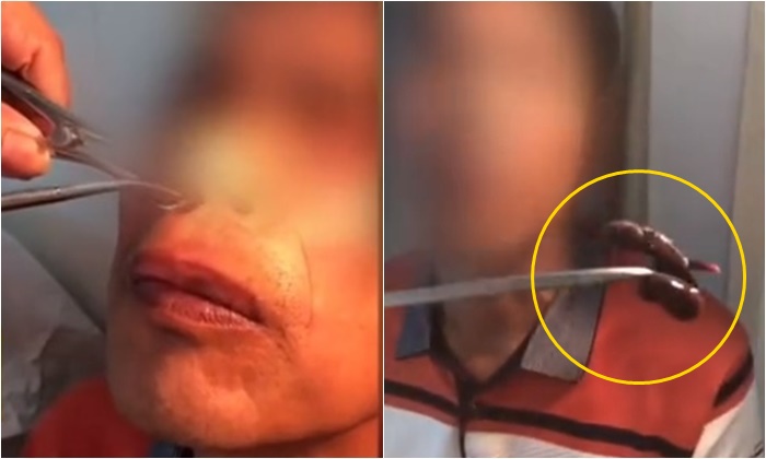 สุดสยอง หมอคีบ “ปลิง” ออกจากจมูกชายจีน พยาบาลเห็นแทบเป็นลม