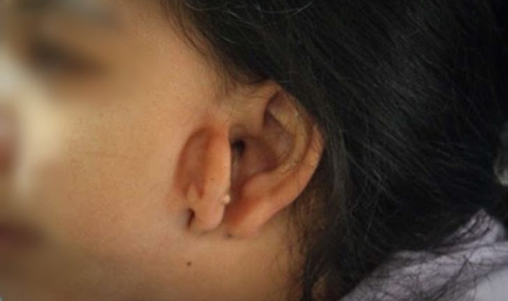 ปวีณาช่วยด้วย แม่จูงมือลูกวัย 13 เนื้องอกทำตาเริ่มมองไม่เห็น ใบหูที่ 3 โผล่