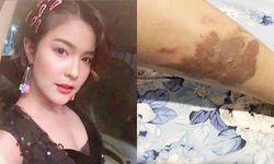 "เปาวลี" อัปเดตแผลพุพองที่ขา หลังถูกน้ำมันร้อนหกใส่