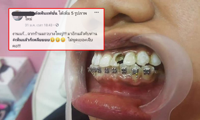 ยิ่งกว่าตลกร้าย จัดฟันแฟชั่นจนฟันพัง แล้วยังไปแก้ที่ร้านเถื่อนอีก