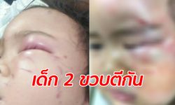 ครูปล่อยเด็กอยู่ลำพัง หนูน้อย 2 ขวบ โดนของเล่นฟาด แผลปูดบวมช้ำทั้งหน้า