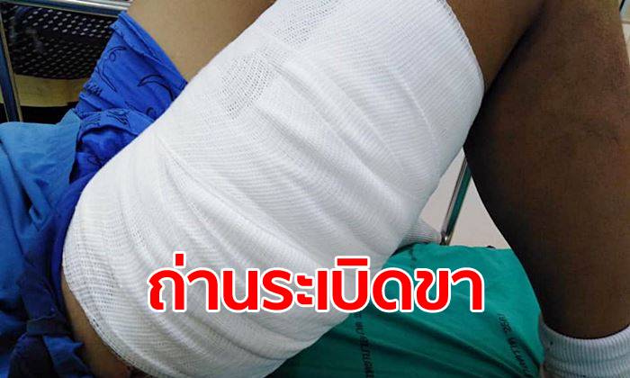 เด็กชายเก็บ "ถ่านชาร์จพัดลม" ไว้ในกระเป๋ากางเกง เล่นตะกร้ออยู่ดีๆ ระเบิดไฟลุกไหม้ขา