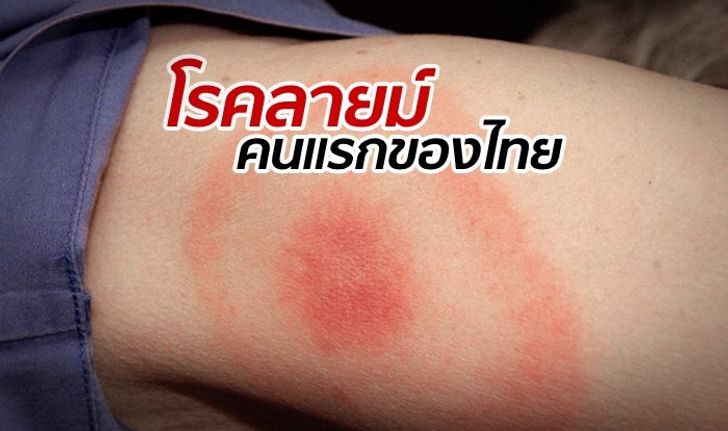 หญิงไทยป่วย "โรคลายม์" รายแรกของประเทศ รักษาได้ทัน แต่ความทรงจำหาย
