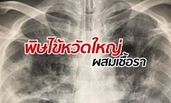 ชายไทยป่วยโรคไข้หวัดใหญ่ "ผสมภาวะติดเชื้อราในอากาศ" ไม่ถึง 30 วันเสียชีวิต