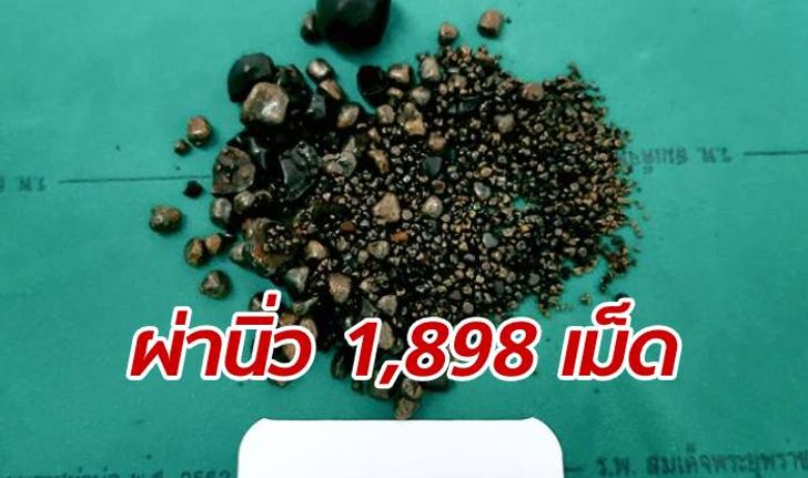 หมอหนองคายทำสถิติใหม่ ผ่าตัดนิ่วในถุงน้ำดี ได้จำนวน 1,898 เม็ด