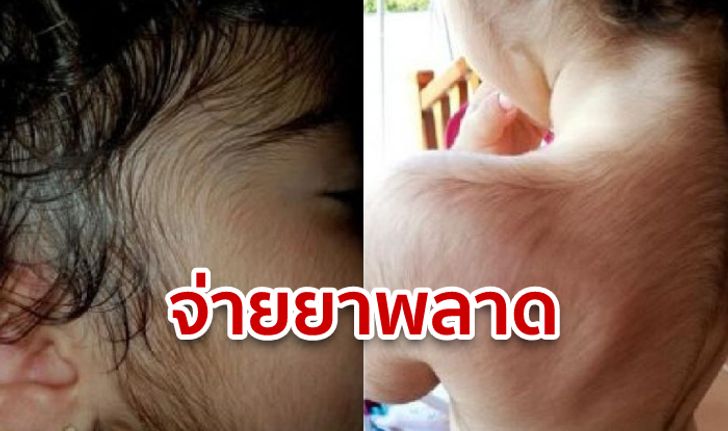 ครอบครัวสเปนฟ้องบริษัทยา หลังเด็ก 20 คน ป่วยโรคขนงอกผิดปกติ เพราะยาโดนสลับฉลาก