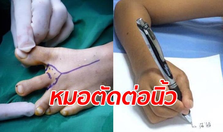 หมอไทยสุดเจ๋ง เด็กชาย 7 ขวบ นิ้วหัวแม่มือขาด ผ่าตัดเอานิ้วเท้าต่อให้แทน