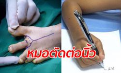 หมอไทยสุดเจ๋ง เด็กชาย 7 ขวบ นิ้วหัวแม่มือขาด ผ่าตัดเอานิ้วเท้าต่อให้แทน