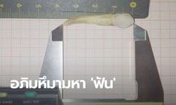 ทันตแพทย์เยอรมนีอึ้ง! เจอโคตรฟัน ยาวที่สุดในโลก หลังคนไข้มาถอนเพราะทนปวดไม่ไหว