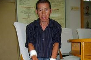 จีนเจ๋งประสบความสำเร็จรักษา มนุษย์ผิวหนังปะการัง