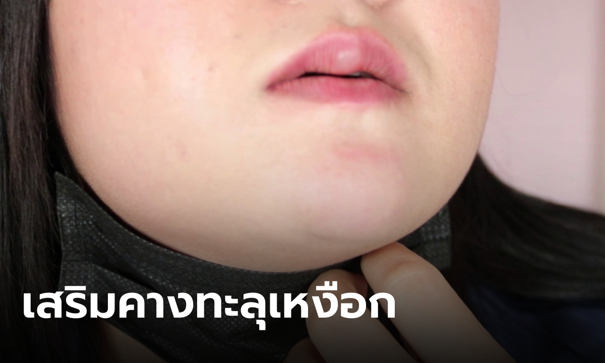 อยากสวยแต่ซวย! หมอให้พนักงานเสริมคางแทน สาวสุดช็อกซิลิโคนทะลุเหงือก