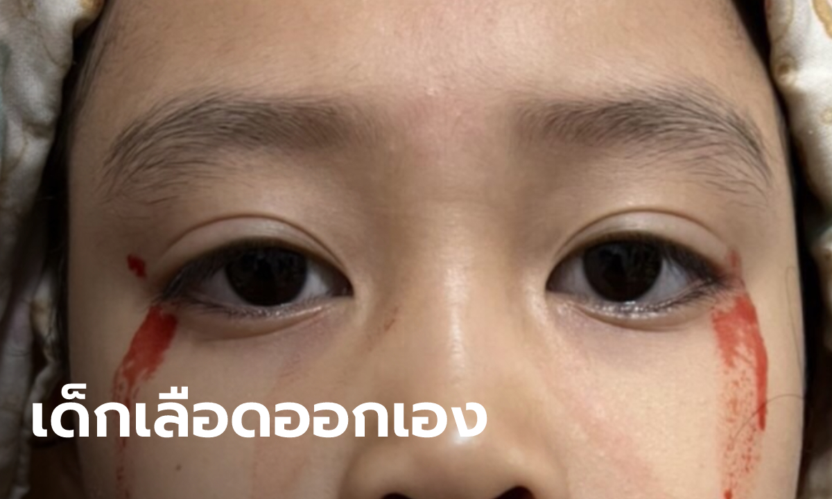 เด็กหญิง 7 ขวบ เลือดออกตา-จมูก-ผิวหนัง ไม่ทราบสาเหตุ คาดโรคเหงื่อออกเป็นเลือด