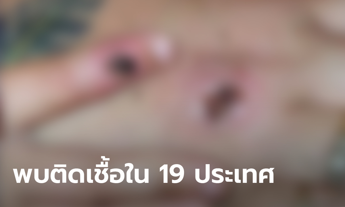 ฝีดาษลิงยืนยันแล้ว 221 รายใน 19 ประเทศ อนามัยโลกลั่นเอาอยู่