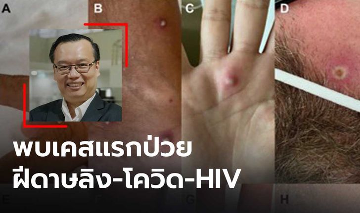 "ดร.อนันต์" เผย พบผู้ป่วยชายในอิตาลี ติดเชื้อฝีดาษลิง-โควิด และ HIV พร้อมกัน