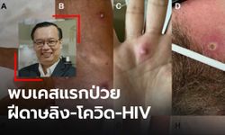 "ดร.อนันต์" เผย พบผู้ป่วยชายในอิตาลี ติดเชื้อฝีดาษลิง-โควิด และ HIV พร้อมกัน