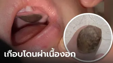 เคสช็อก แพทย์จีนวินิจฉัยพลาด บอกเด็กมี "เนื้องอกในปาก" ที่แท้แค่ของกินติดเพดาน