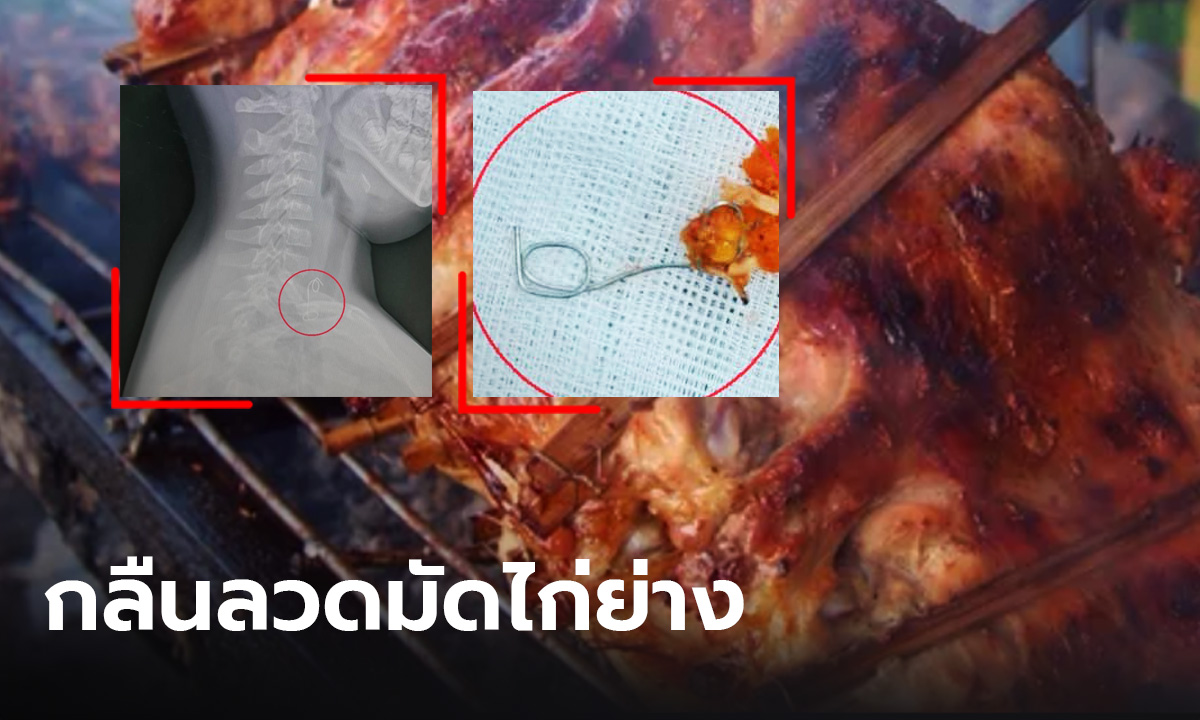 หมอโพสต์เตือน เด็กเผลอกลืน "ลวดมัดไก่ย่าง" ต้องเร่งช่วยผ่าตัดฉุกเฉิน