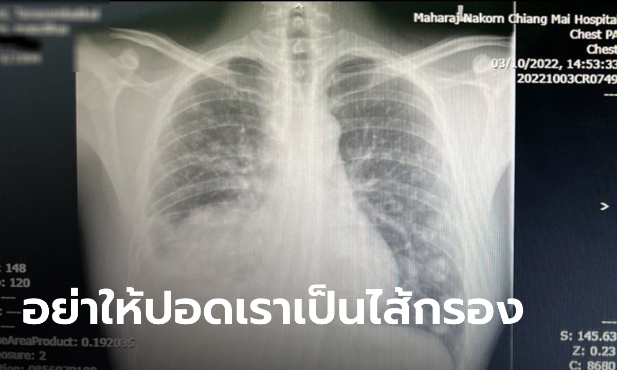 หมอมานพ คาดสาเหตุที่หมอหนุ่มวัย 28 เจ้าของเพจ #สู้ดิวะ ป่วยมะเร็งปอด ทั้งที่ไม่สูบบุหรี่
