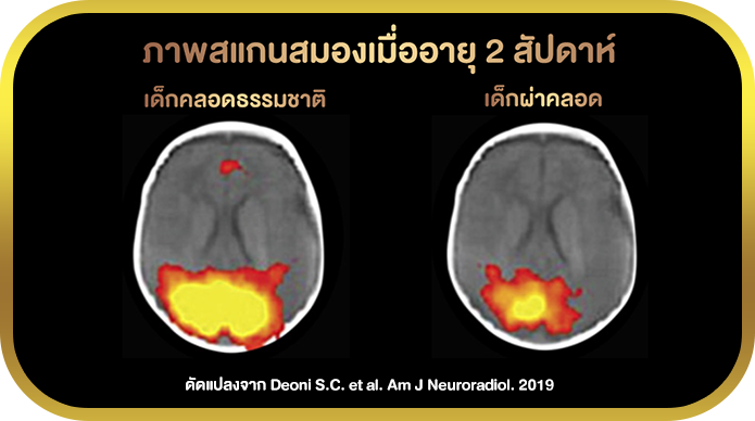 ภาพสแกนสมองเมื่ออายุ 2 สัปดาห์2 เด็กคลอดธรรมชาติและเด็กผ่าคลอด ภาพสแกนสมองเมื่ออายุ 2 สัปดาห์2 ดัดแปลงจาก Deoni S.C. et al. Am J Neuroradiol. 2019 2