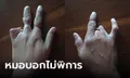 สาวข้องใจ นิ้วมือผิดปกติแต่กำเนิด แต่ทำบัตรคนพิการไม่ได้ หมอบอกไม่เข้าเกณฑ์