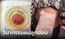 สาวสุดทรมาน หมอทำคลอดกรีดแผลยาวถึงทวาร ลำไส้แตก ทุกข์ซ้ำผัวทิ้งไปมีใหม่