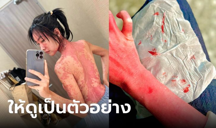 สาวแชร์ชีวิตป่วยแพ้ภูมิตัวเอง ถึงขั้นติดเตียง-เลือดซึมออกผิว บทเรียนคนไม่ดูแลสุขภาพ