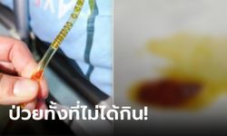 หญิงวัย 58 อาเจียนรุนแรง เสี่ยงมะเร็งตับ หมอเผยต้นเหตุเพราะ "คนในบ้าน" กินของดิบ