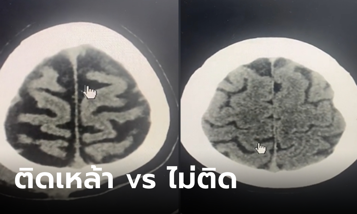 หมอเปิดภาพสแกนสมอง เทียบชัดๆ ผู้ป่วยรถล้ม 2 ราย คนนึงติดเหล้า อีกคนไม่ติด