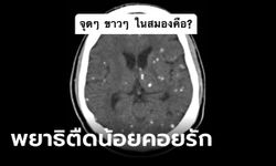 สะพรึง หมอเอกซเรย์คนไข้ เจอจุดขาวๆ ในสมอง กินผักเพื่อสุขภาพดี กลับมีพยาธิเต็มหัว