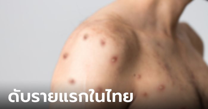 ผู้ติดเชื้อเอชไอวีป่วย "ฝีดาษลิง" เสียชีวิตรายแรกในไทย เป็นชายอายุ 34 ปี