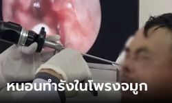 ชายเลือดกำเดาไหลไม่หยุด ช็อก ส่องกล้องดูโพรงจมูก เจอหนอนตัวเป็นๆ นับร้อย