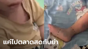 พ่อ-ย่าใจสลาย ด.ช. 2 ขวบ อาจต้องถูกตัดเท้าขวา ช็อกจุดเริ่มต้นจากพาไปตลาด