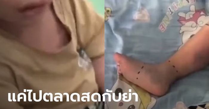 พ่อ-ย่าใจสลาย ด.ช. 2 ขวบ อาจต้องถูกตัดเท้าขวา ช็อกจุดเริ่มต้นจากพาไปตลาด