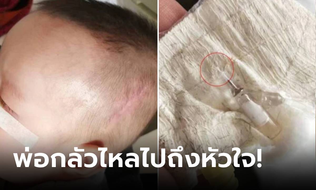 หัวอกพ่อ... พยาบาล "ลืม" หลอดเข็มไว้ในหัวลูกชาย ผ่านมา 5 ปี ไหลลงมาอยู่ตรงนี้!