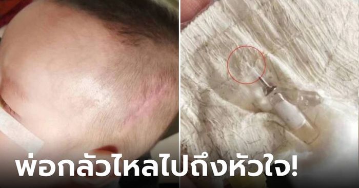 หัวอกพ่อ… พยาบาล "ลืม" หลอดเข็มไว้ในหัวลูกชาย ผ่านมา 5 ปี ไหลลงมาอยู่ตรงนี้!