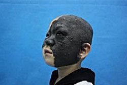เด็กหญิง4ขวบจีน เผชิญโรคหน้าดำ ลุ้นผ่าตัดหาย