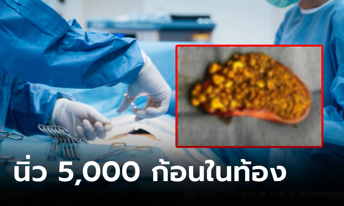 เป็นได้ขนาดนี้! หมอผ่านิ่ว 5,000 ก้อน ขนลุกเผย "อาหาร" ที่คนไข้ชอบ เมนูฮิตคนทุกวัย