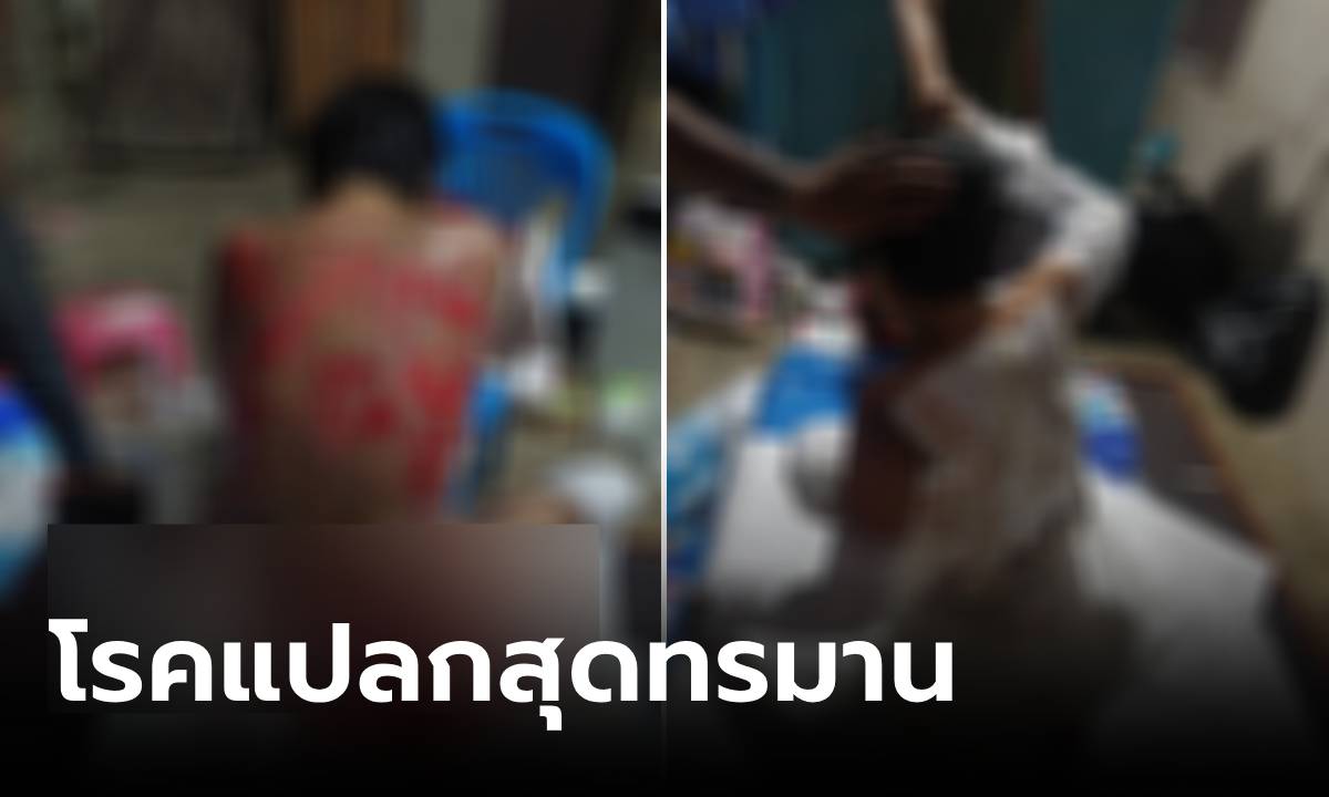 แสบทรมาน หญิงป่วยโรคประหลาด แผลคล้ายโดนลวกผุดเต็มตัว ต้องใช้ชีวิตในมุ้ง 5 ปีเต็ม