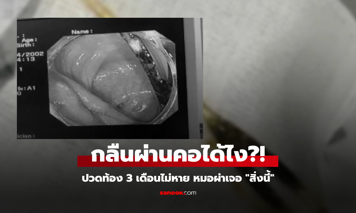 เกือบจัดงานศพ หนุ่มปวดท้องเป็นเดือนๆ ไม่หาย หมอผ่า "สิ่งนี้" ออกมา ตาตื่นทั้งครอบครัว!