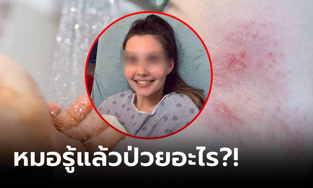 สาวป่วยแปลก "แพ้น้ำ" สัมผัสแล้วถึงขั้น "เลือดออกหัว" ทรมานดื่มได้แค่ 1 สิ่งประทังชีวิต