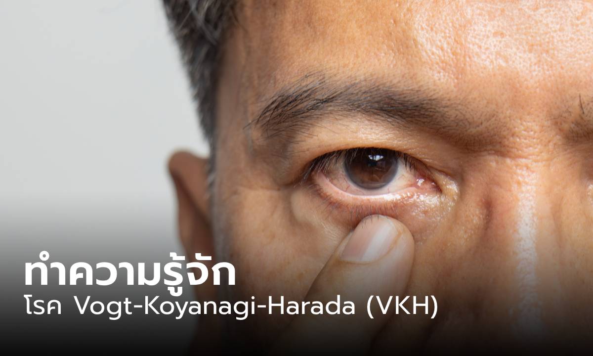 รู้จัก “โรค Vogt Koyanagi Harada (VKH) ” คืออะไร หลัง 'กิต Three Man Down' ป่วย