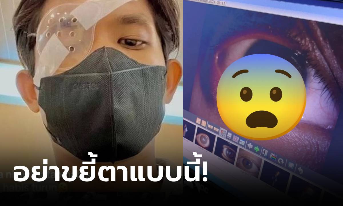 หนุ่มมาเตือนเอง อายุแค่ 21 ต้องเข้า "ผ่าตัด" เพราะติดนิสัย "ขยี้ตา" แบบที่หลายคนชอบทำ