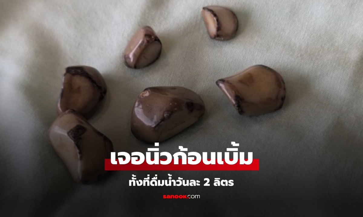 ชายวัย 58 ช็อก ดื่มน้ำวันละ 2 ลิตร! แต่พบ "นิ่วขนาดใหญ่ 6 ก้อน" หมอเฉลยสาเหตุ