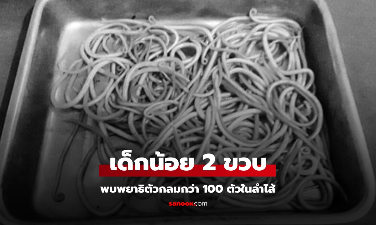 หมอตะลึง พบ "พยาธิตัวกลม" กว่า 100 ตัว ในลำไส้เด็ก 2 ขวบ ต้นเหตุจาก 1 นิสัย