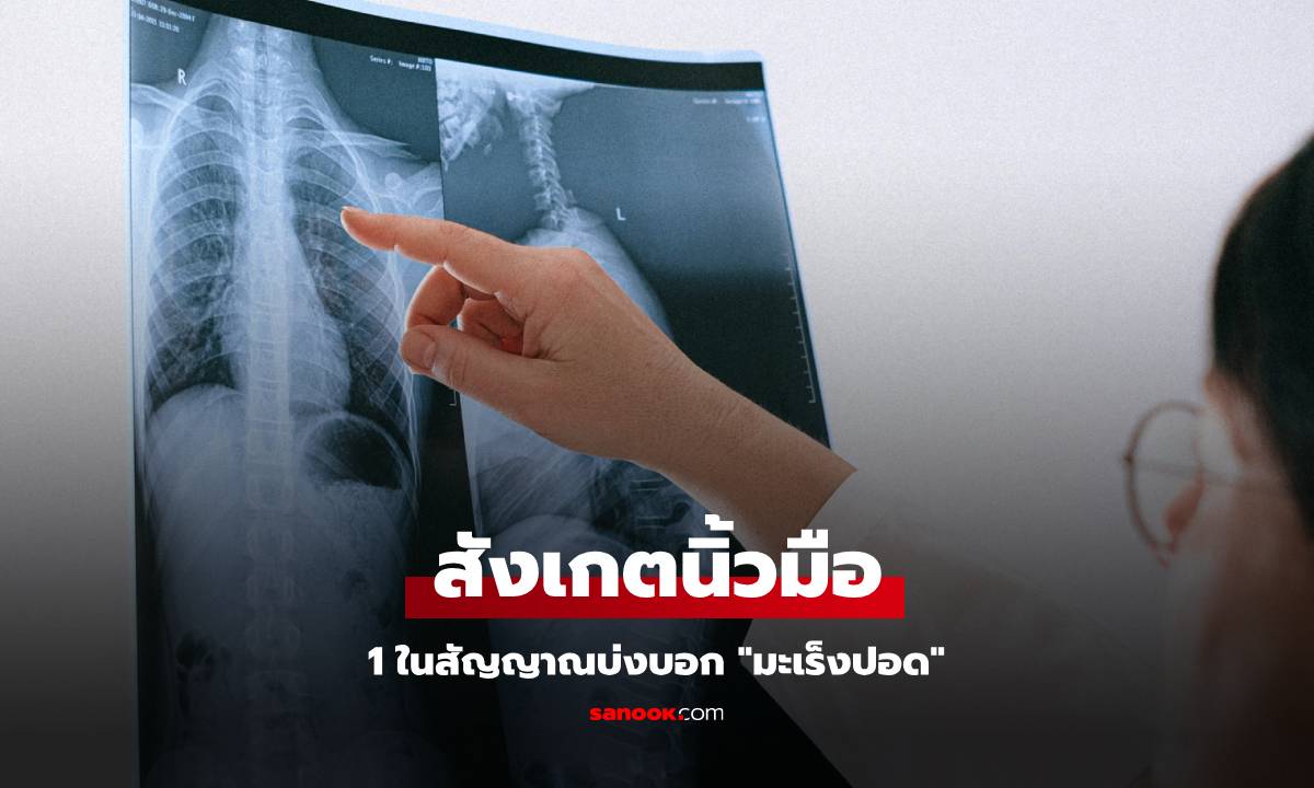 หมอแนะนำ วิธีสังเกตนิ้วมือ สัญญาณบ่งบอก "มะเร็งปอด" ที่หลายคนมักมองข้าม