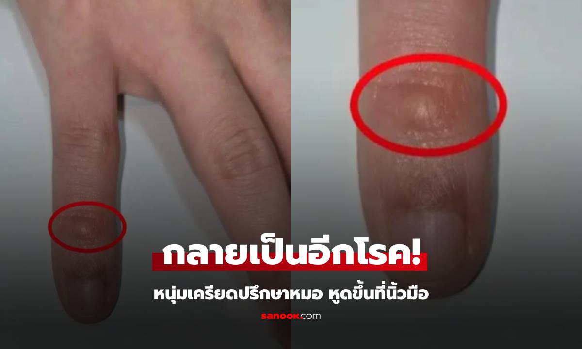 หนุ่มตกใจ "หูด" ขึ้นที่นิ้วมือ หวั่นโรคติดต่อทางเพศฯ เครียดไปปรึกษาหมอ กลายเป็นอีกโรค!