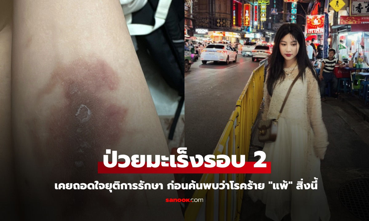 สาววัย 26 รอดตาย "มะเร็งรอบ 2" เคยถอดใจยุติการรักษา ก่อนค้นพบว่าโรคร้าย "แพ้" สิ่งนี้