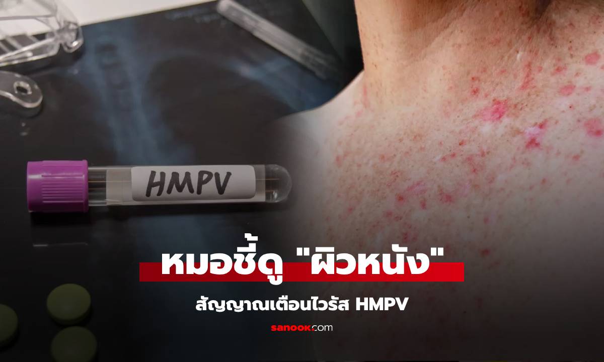 รู้ไว้ดีกว่า! แพทย์อังกฤษเผย สัญญาณเตือนไวรัส HMPV ที่สามารถเห็นได้บน "ผิวหนัง"