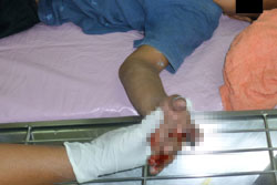 สยอง!! นร.เล่นประทัด โดนระเบิดใส่จนนิ้วขาด